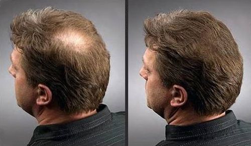 Cápsulas contra alopecia